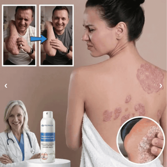 Psoralix™ -ihosuihke | Lievittää psoriasisoireita jo 3 päivässä!